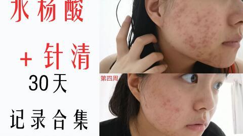 针清痘痘视频,专业操作与注意事项揭秘